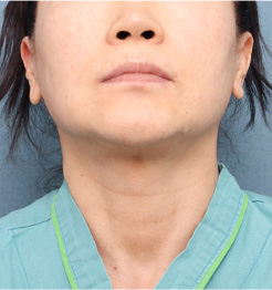 BEFORE 정면