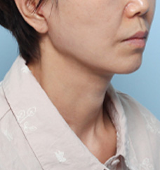 수술 후