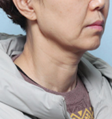 수술 전