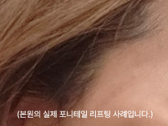 헤어라인 내 최소 절개로 흉터가 거의 보이지 않는 포니테일 리프팅