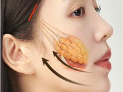 팔자주름·턱선·볼처짐을 한 번에 개선하는 루프 리프팅