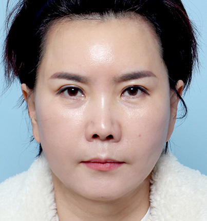 수술 후