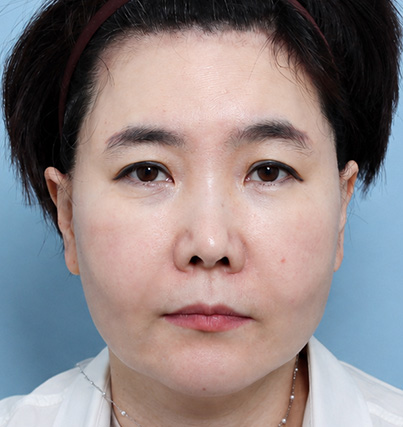 수술 전