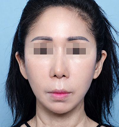 수술 후