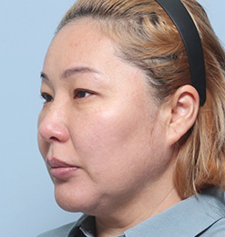 BEFORE 45도