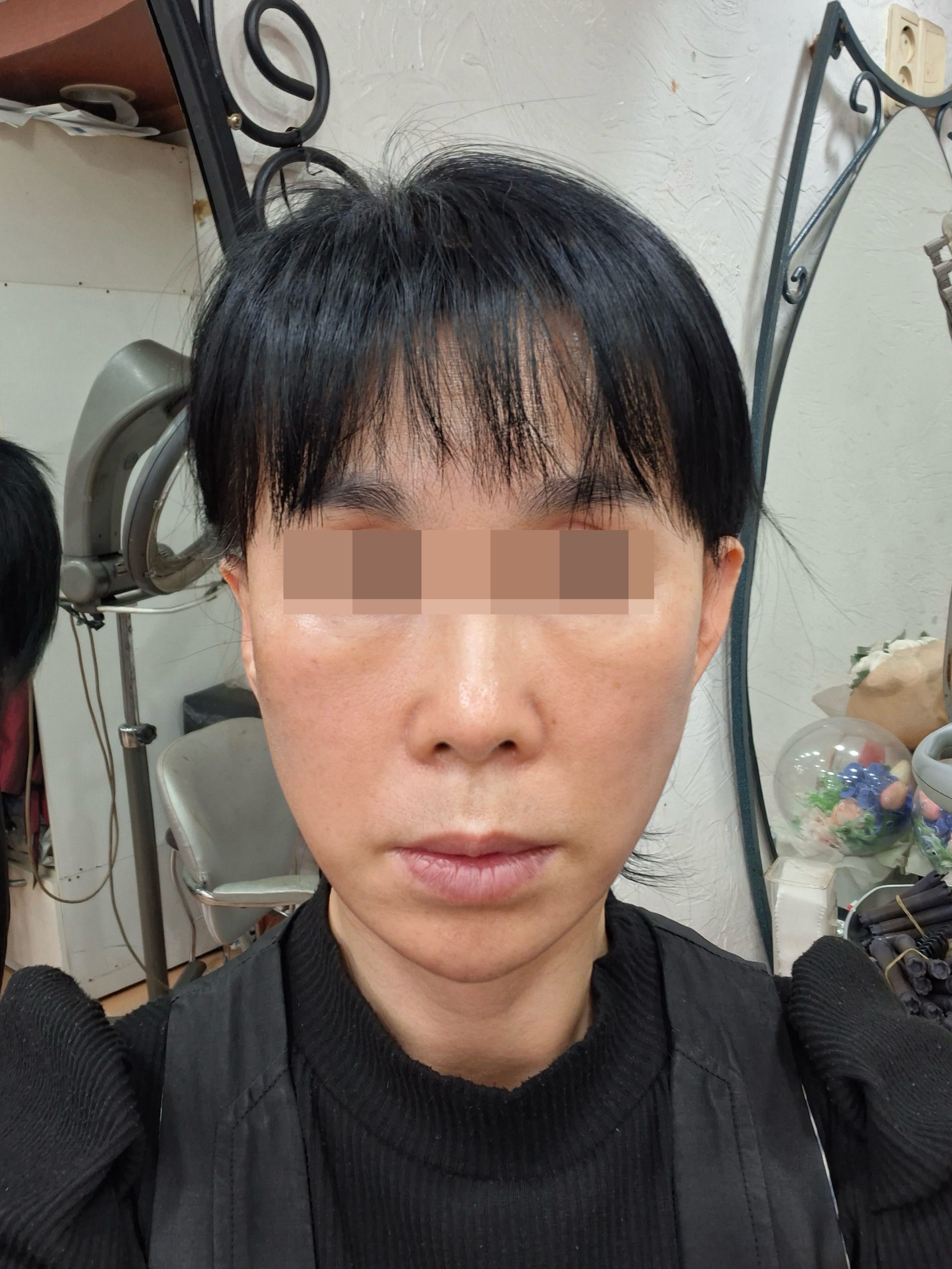 안면거상 수술 후