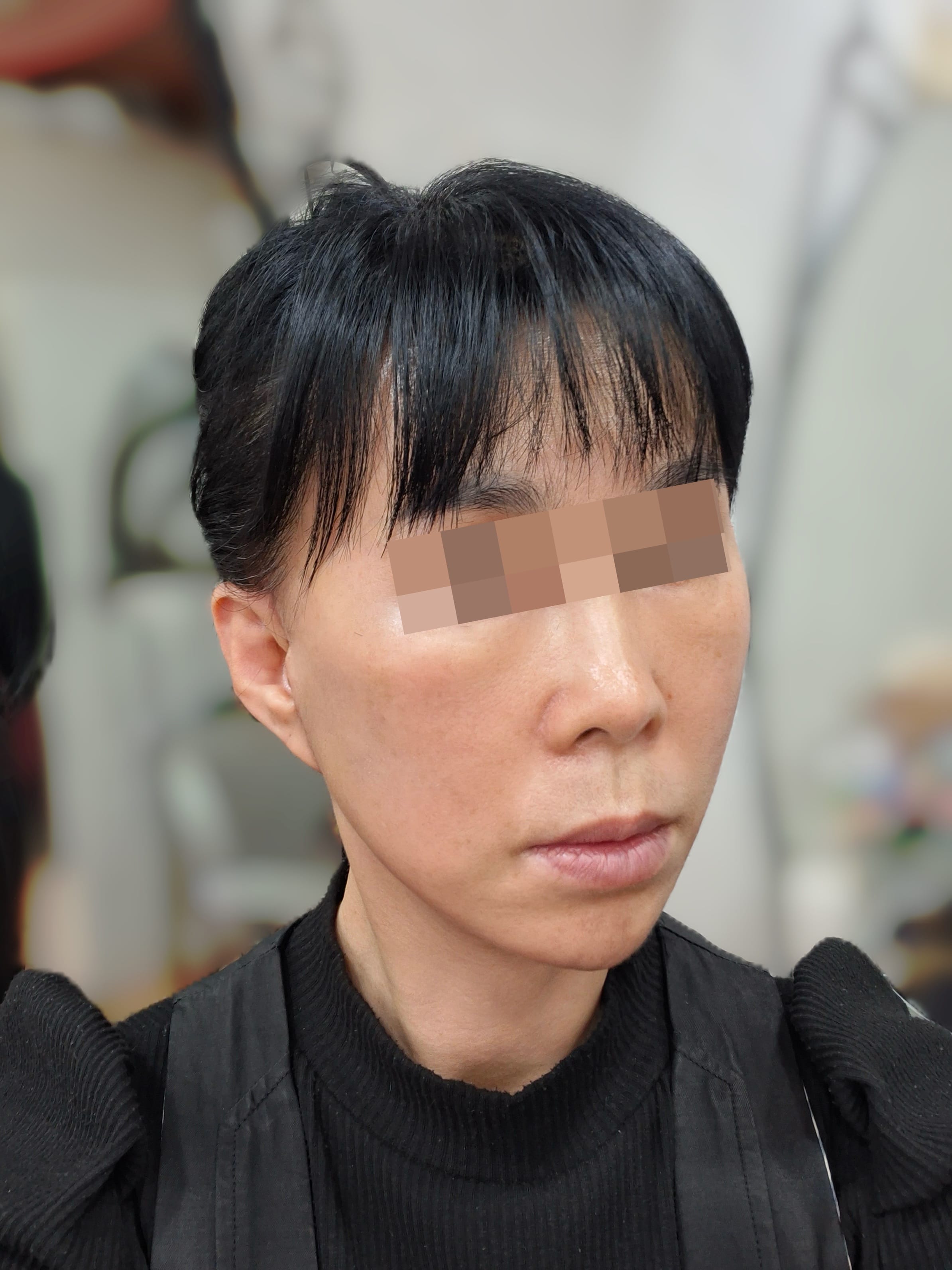 안면거상 수술 후