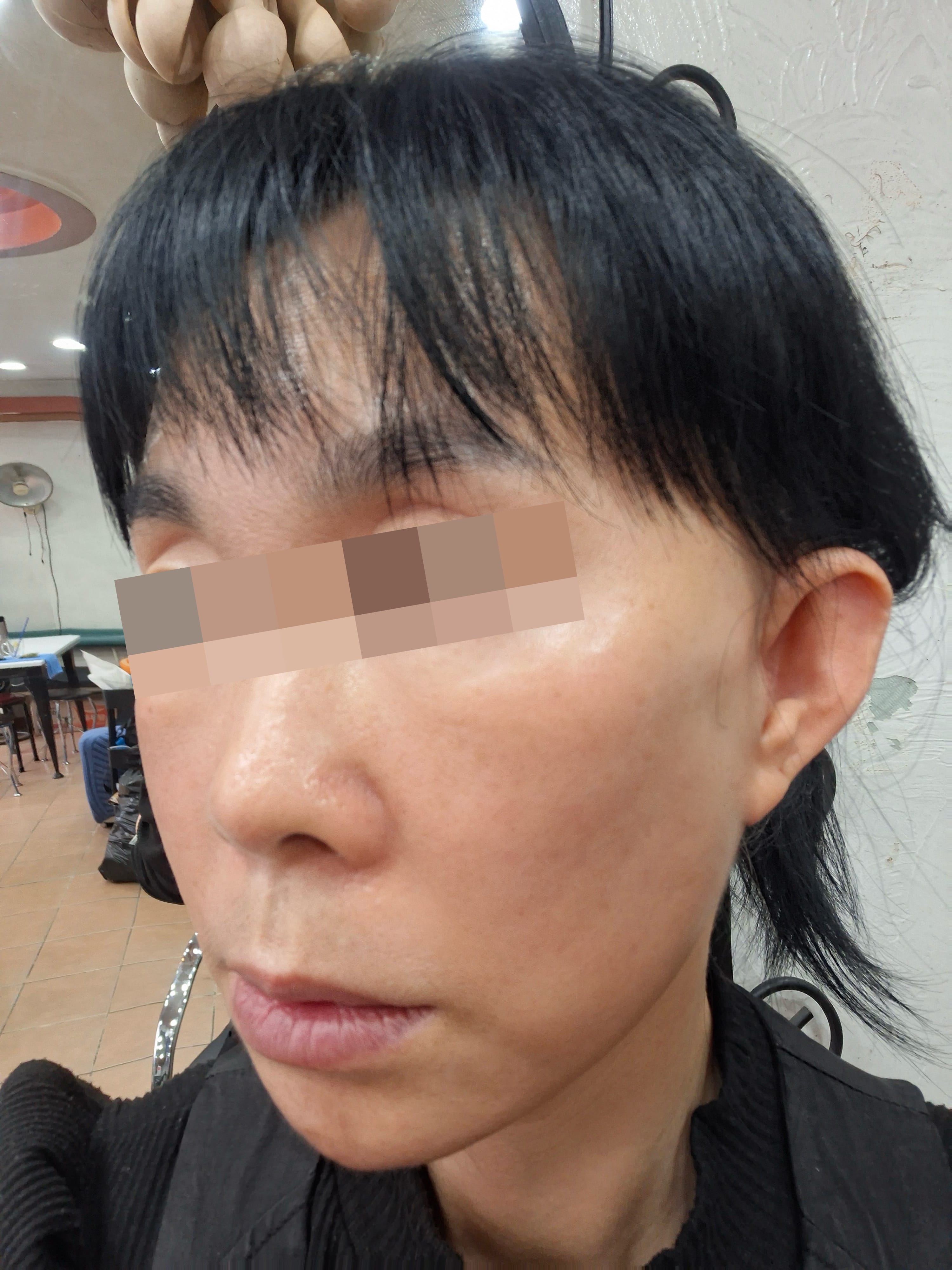 안면거상 수술 후