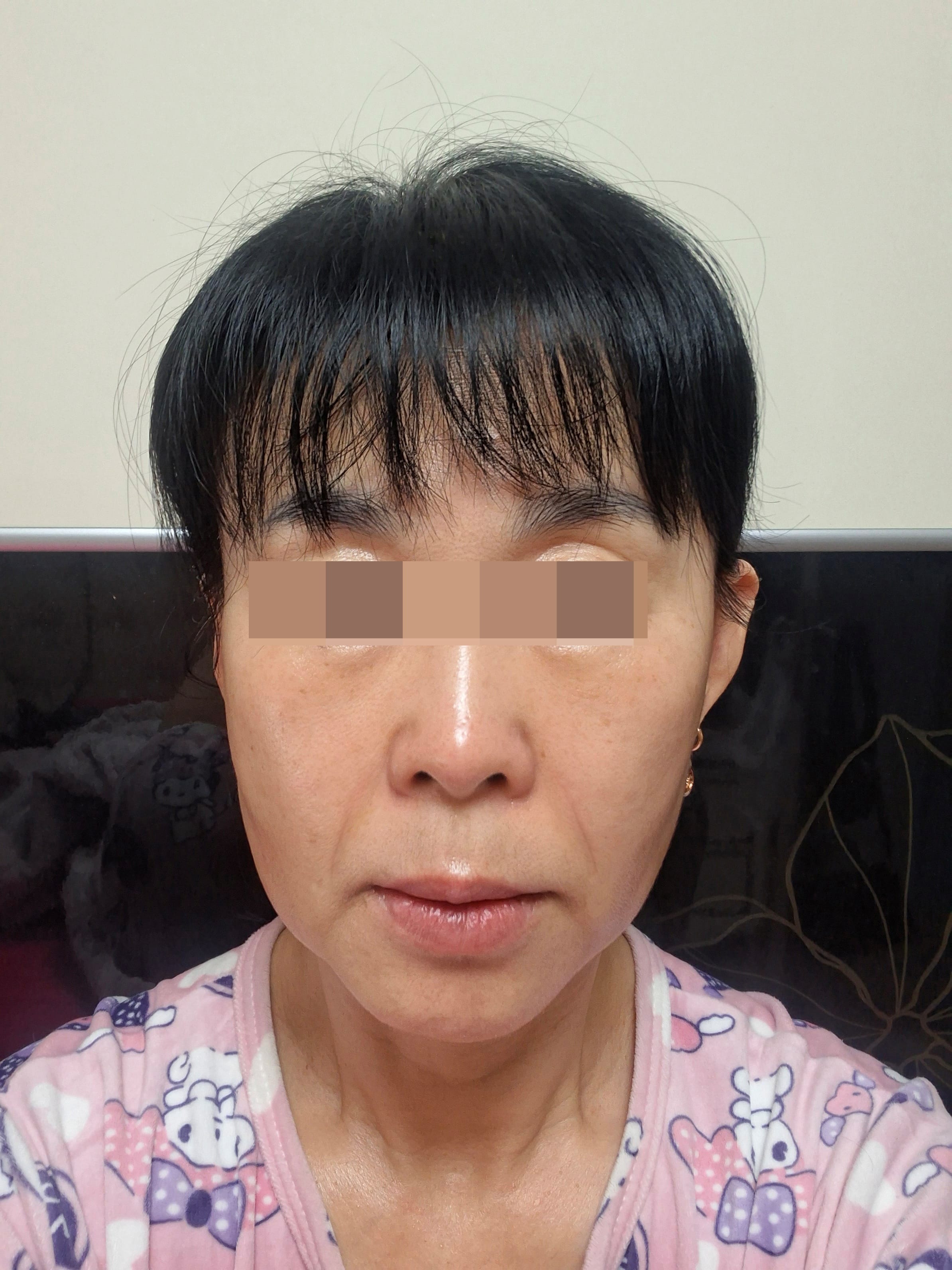 안면거상 수술 전