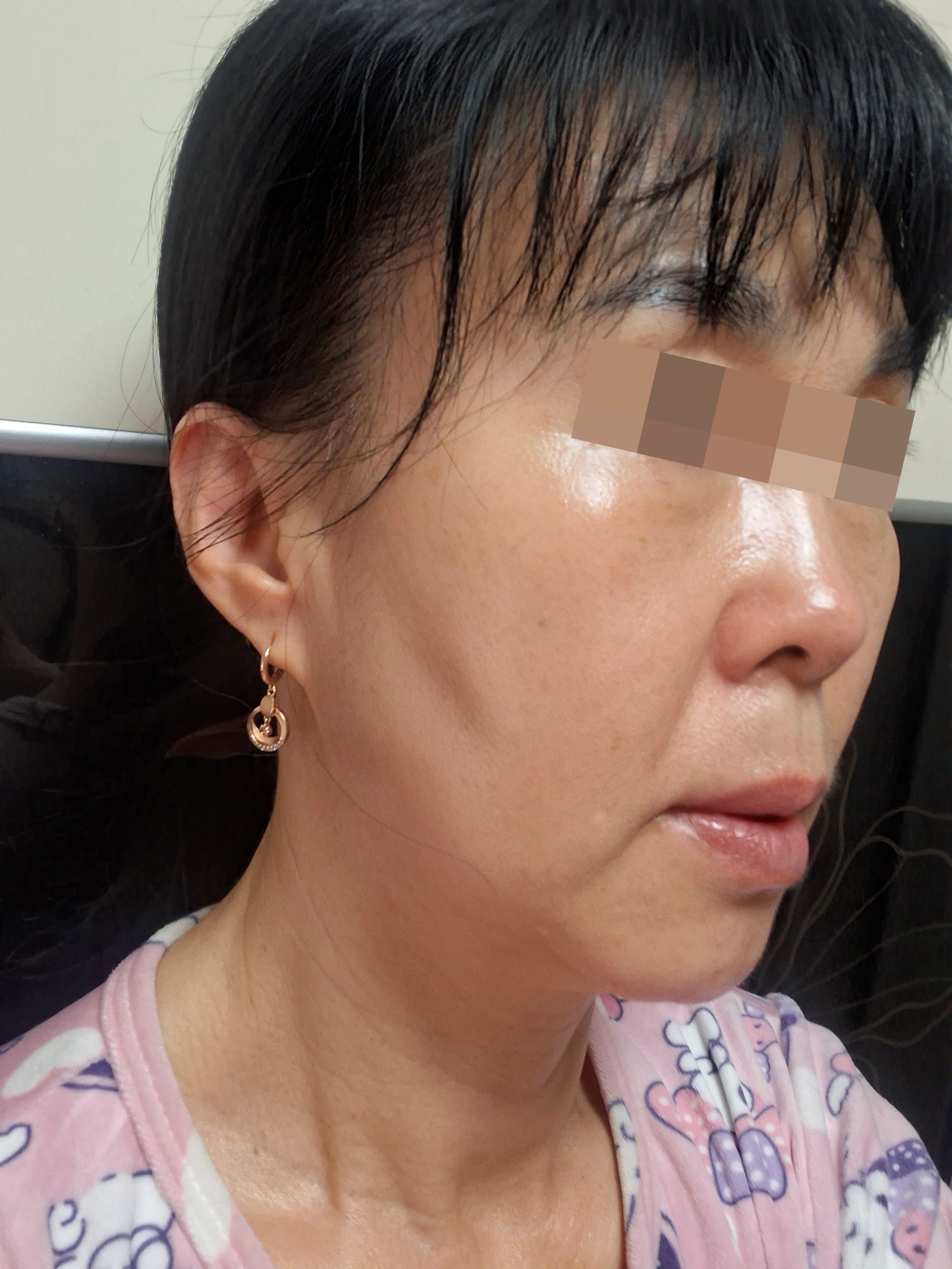 안면거상 수술 전