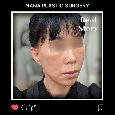 처짐과 팔자주름, 자연스럽게 달라진 안면거상 후기 썸네일