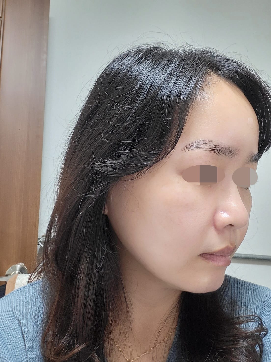 안면거상 수술 후