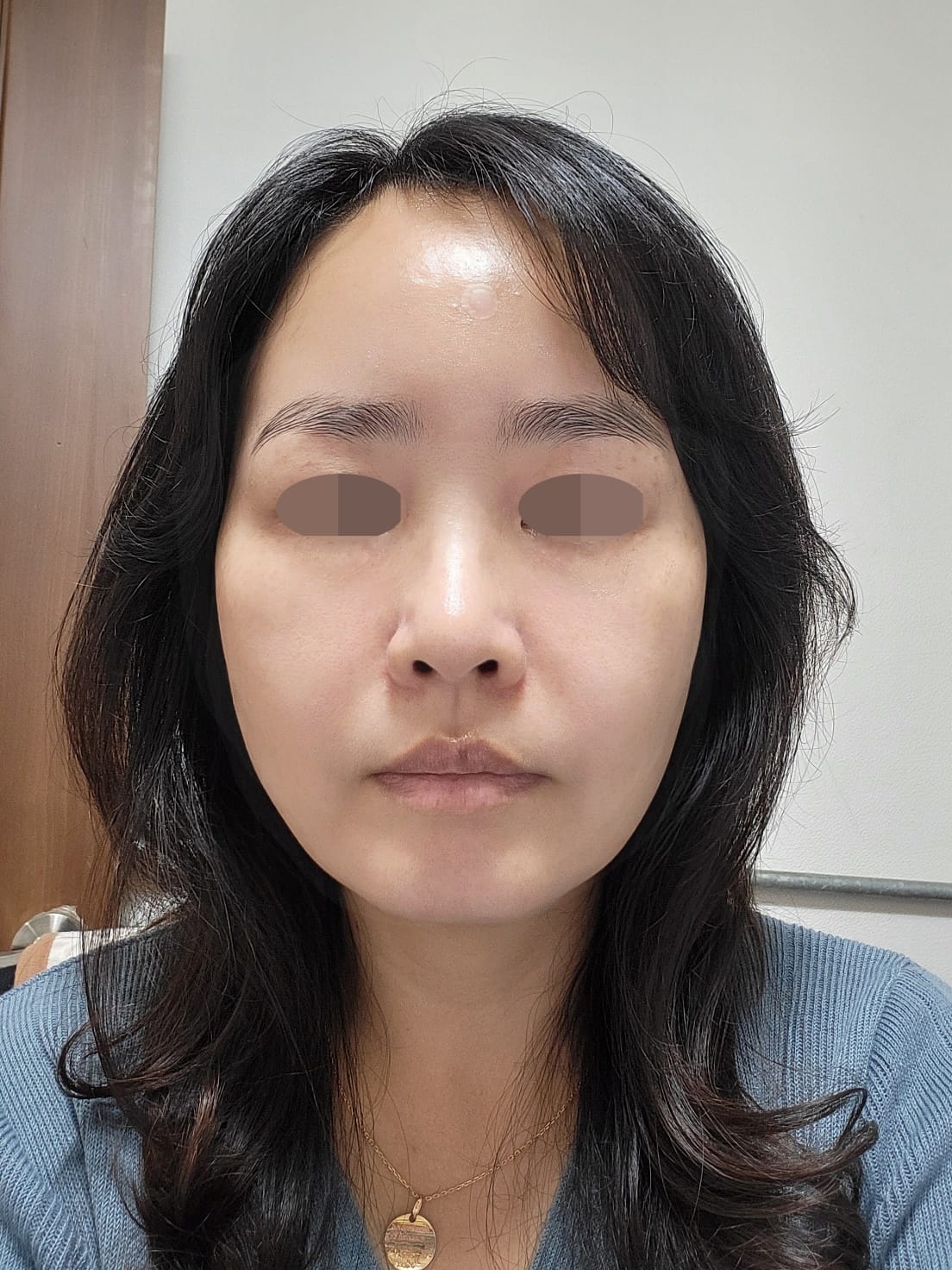 안면거상 수술 후