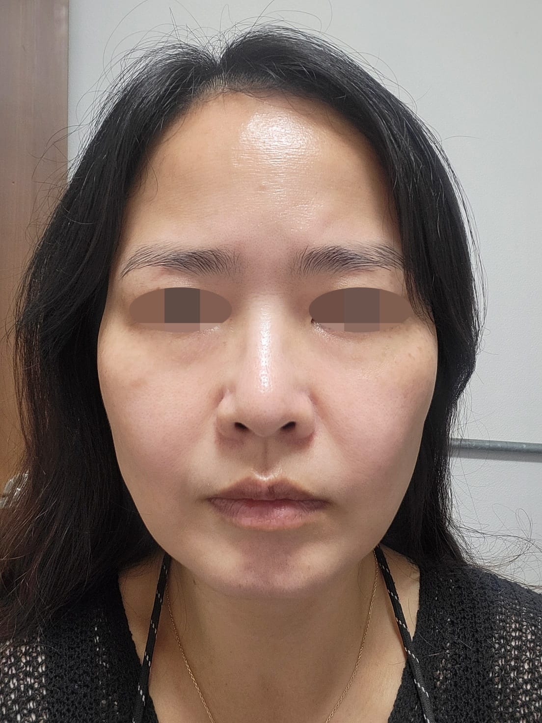 안면거상 수술 전