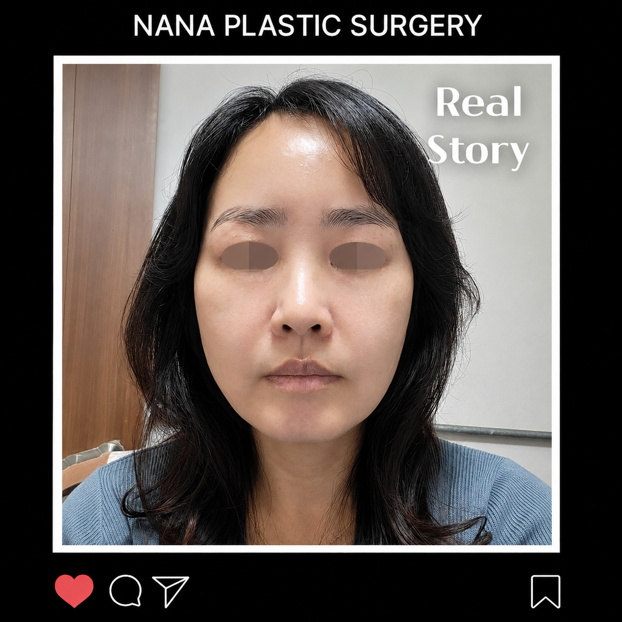 안면거상 리얼후기 썸네일