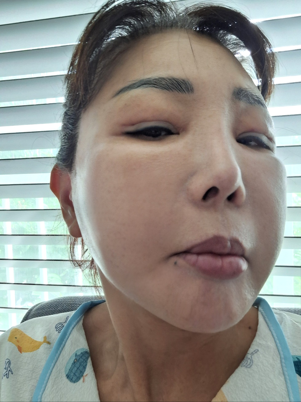 안면거상 수술 후
