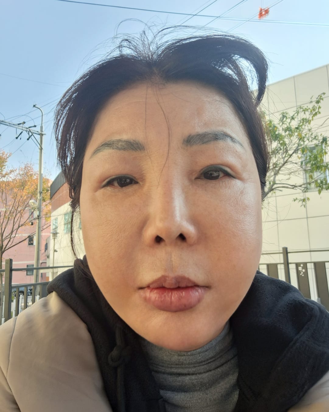 안면거상 수술 후