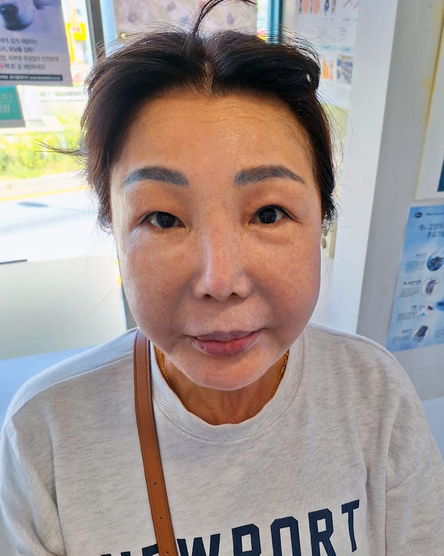 안면거상 수술 전