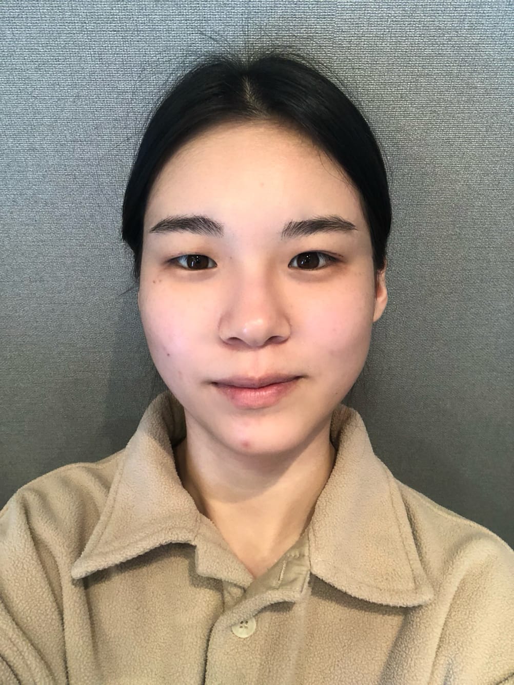 미니거상, 이마거상 수술 전