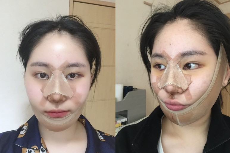 이마거상 수술 전