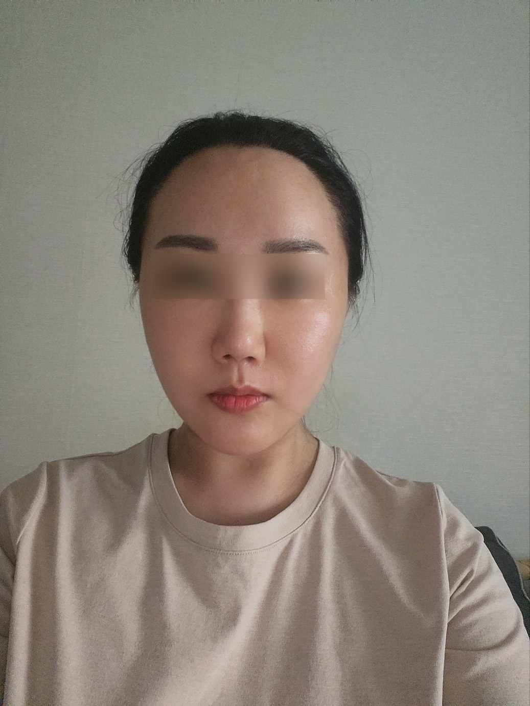 안면거상 수술 후