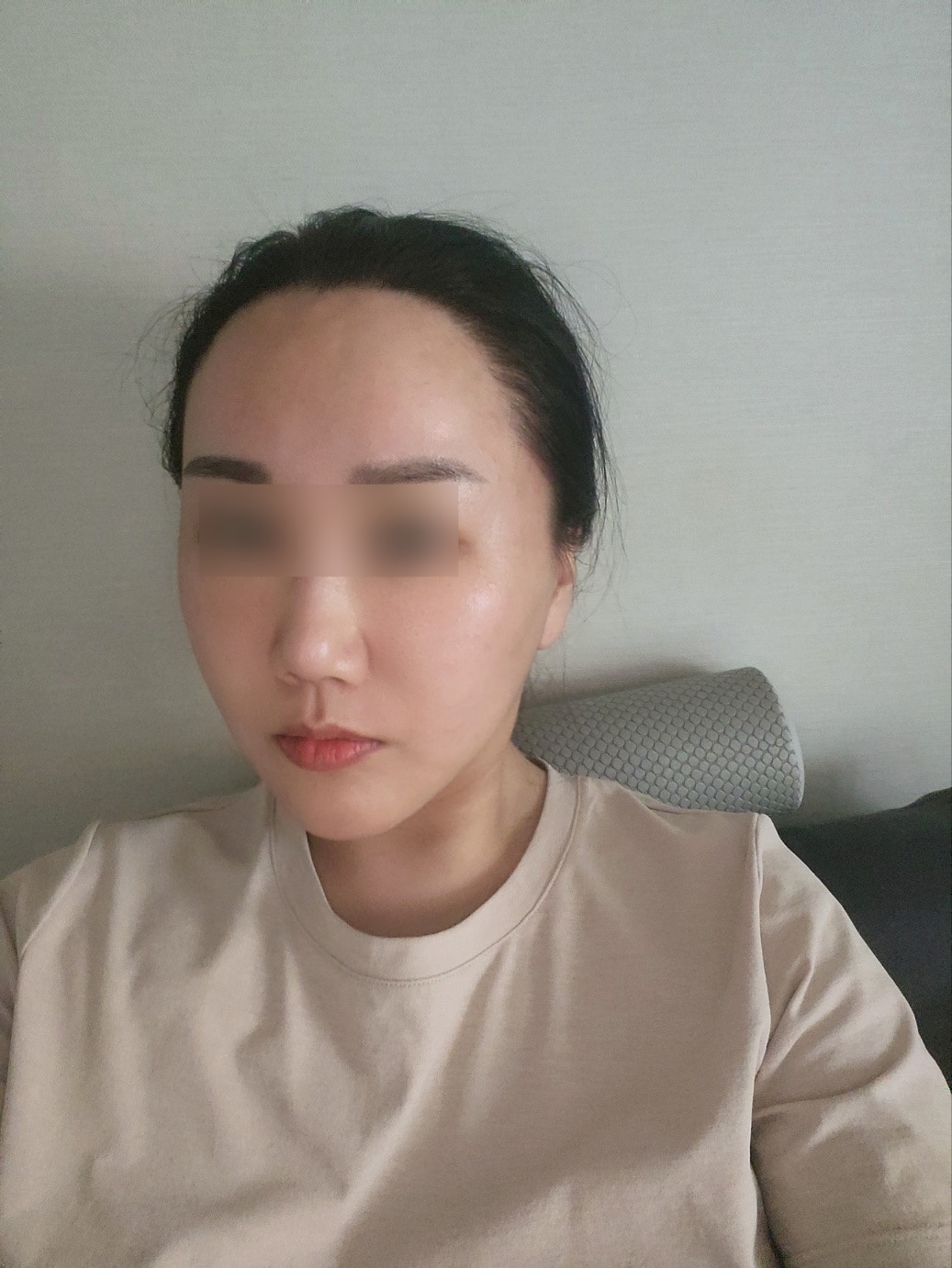 안면거상 수술 후
