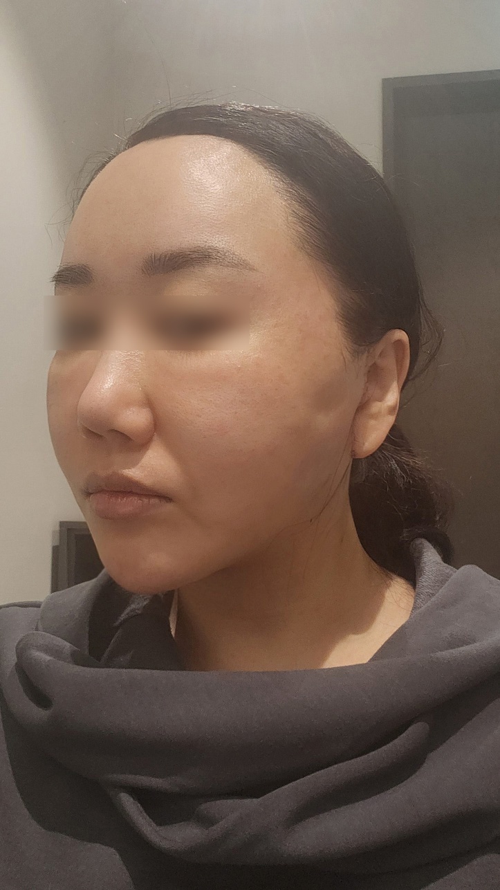 안면거상 수술 전
