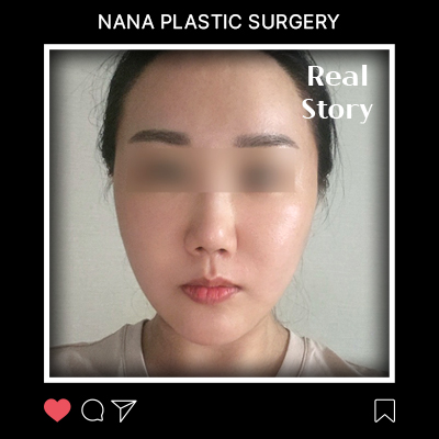코 옆 깊은 주름 고민, 리프팅 후 애프터케어까지 만족한 후기 썸네일