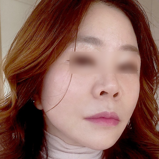 안면거상 수술 후
