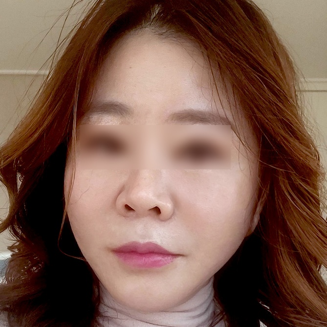 안면거상 수술 후