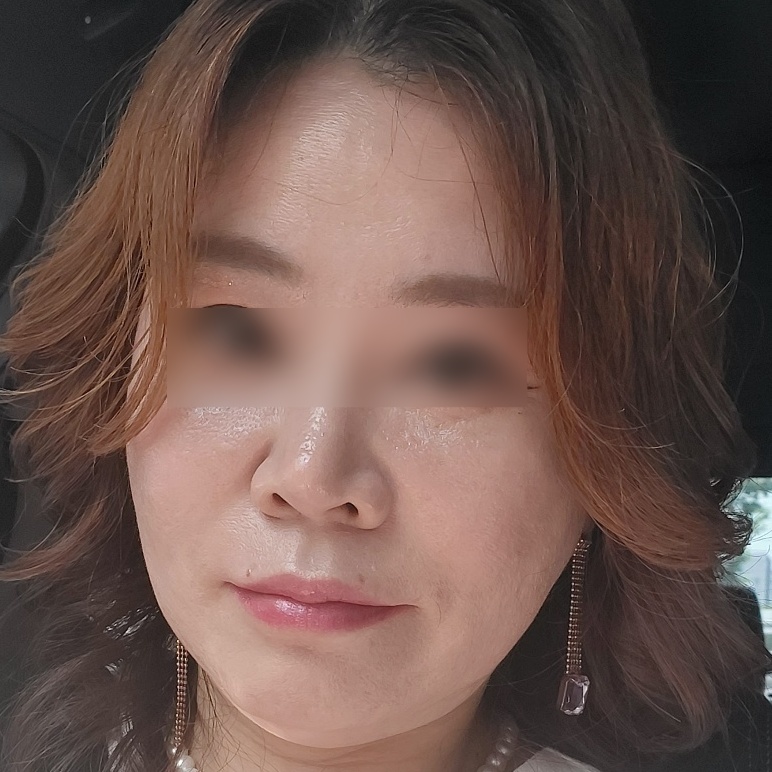 안면거상 수술 전