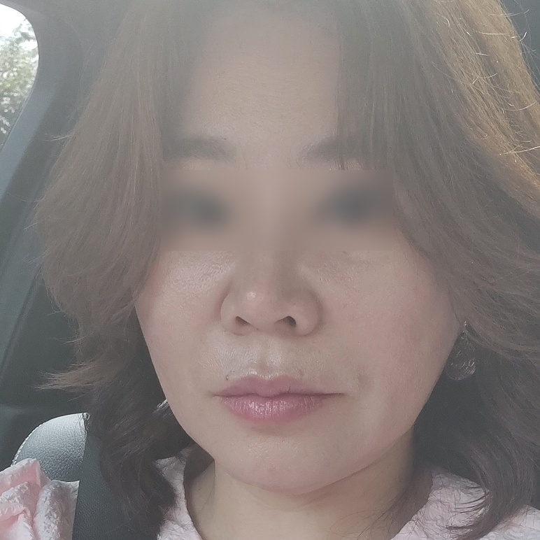 안면거상 수술 전