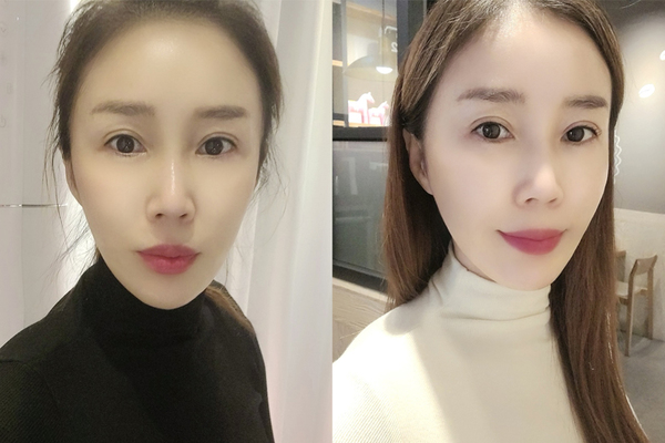 미니거상 수술 후