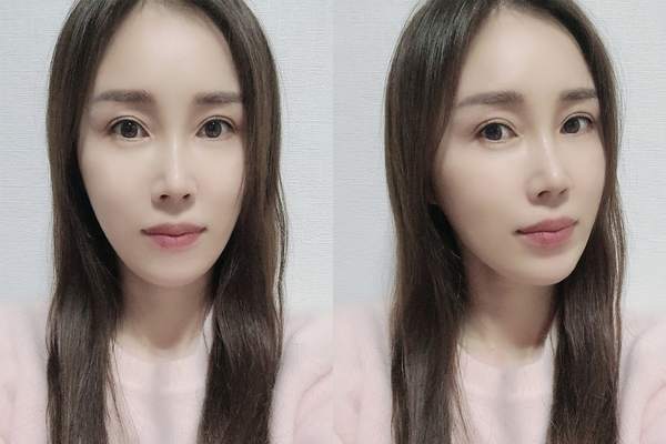 미니거상 수술 후