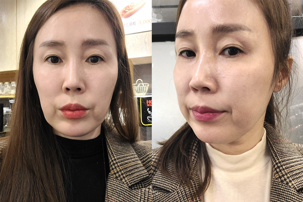 미니거상 수술 전