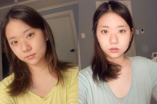 얼굴지방이식 수술 전