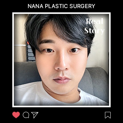 안면거상 전후 변화 리얼후기 썸네일
