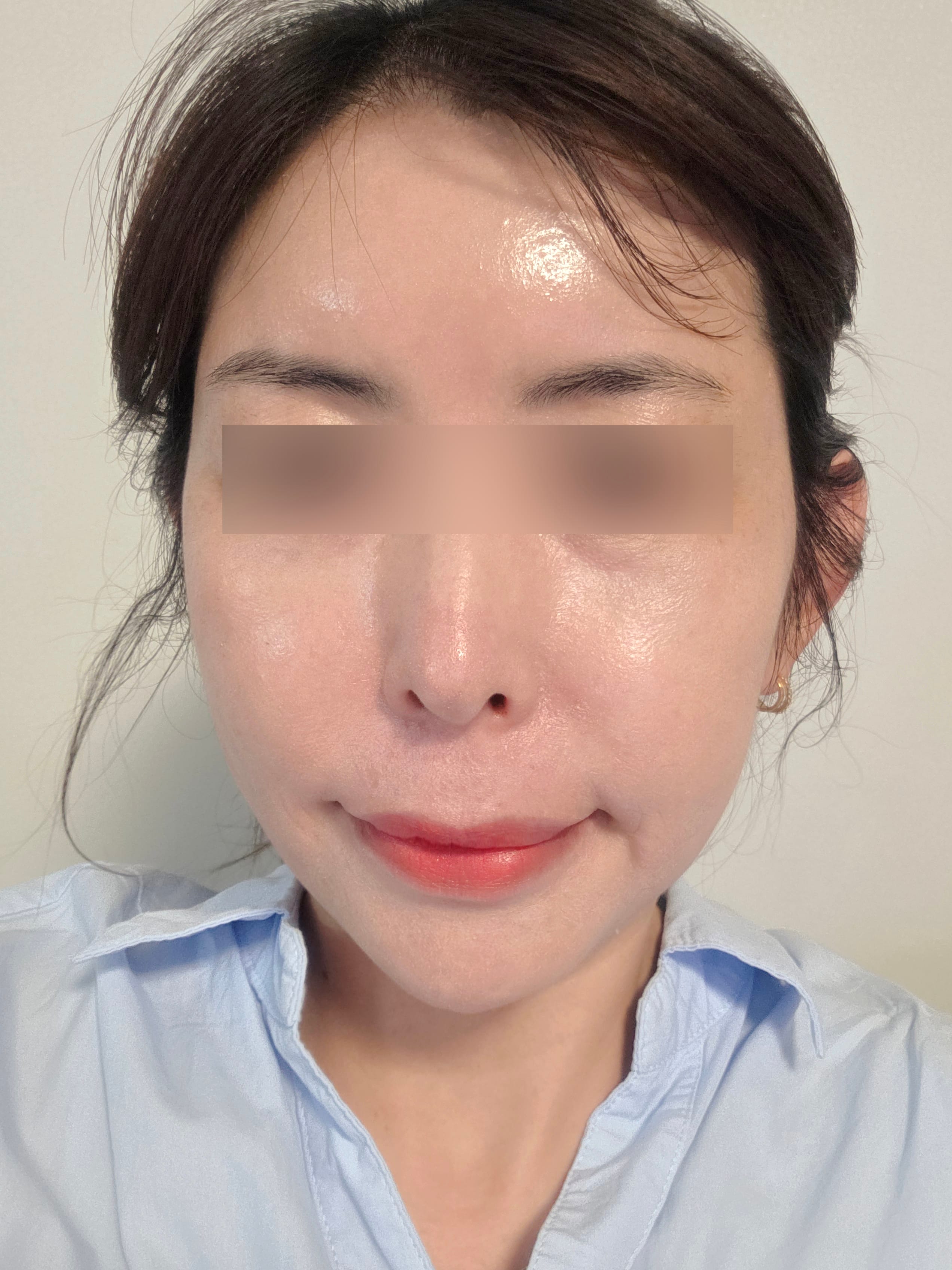 지방이식 수술 후