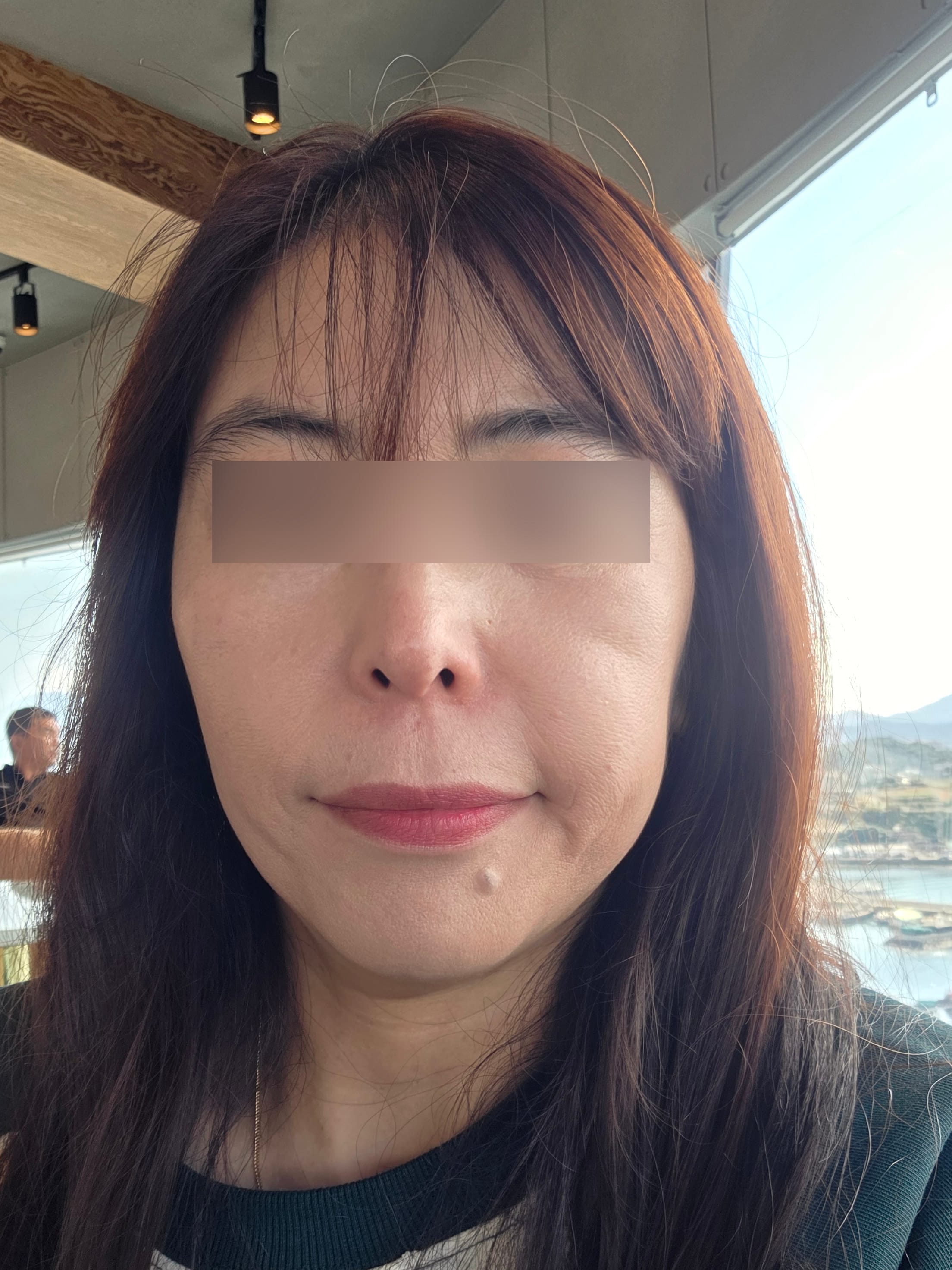지방이식 수술 전