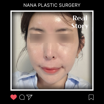 패인 팔자와 처짐, 상담 끝에 되찾은 자신감 후기 썸네일