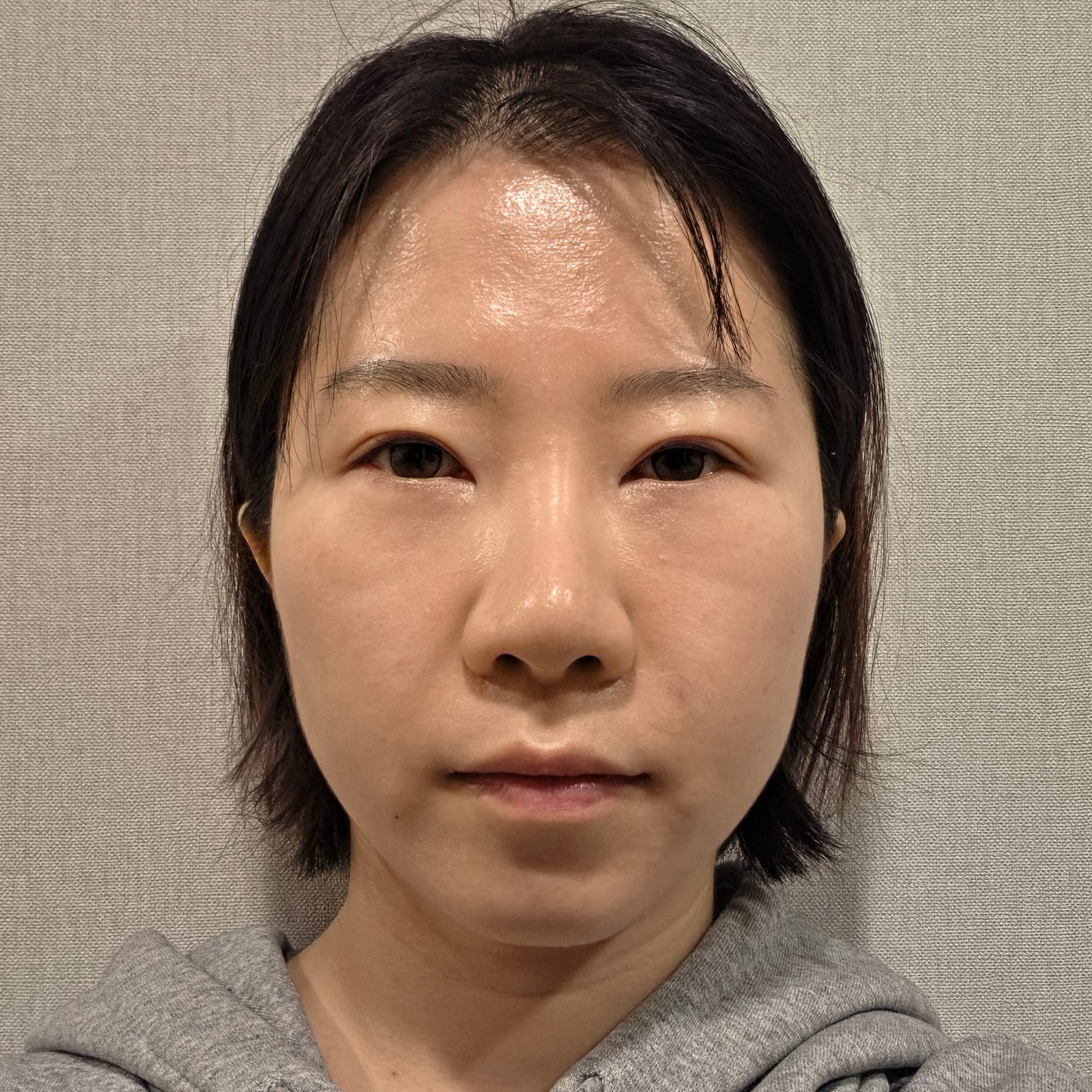 미니거상 수술 전