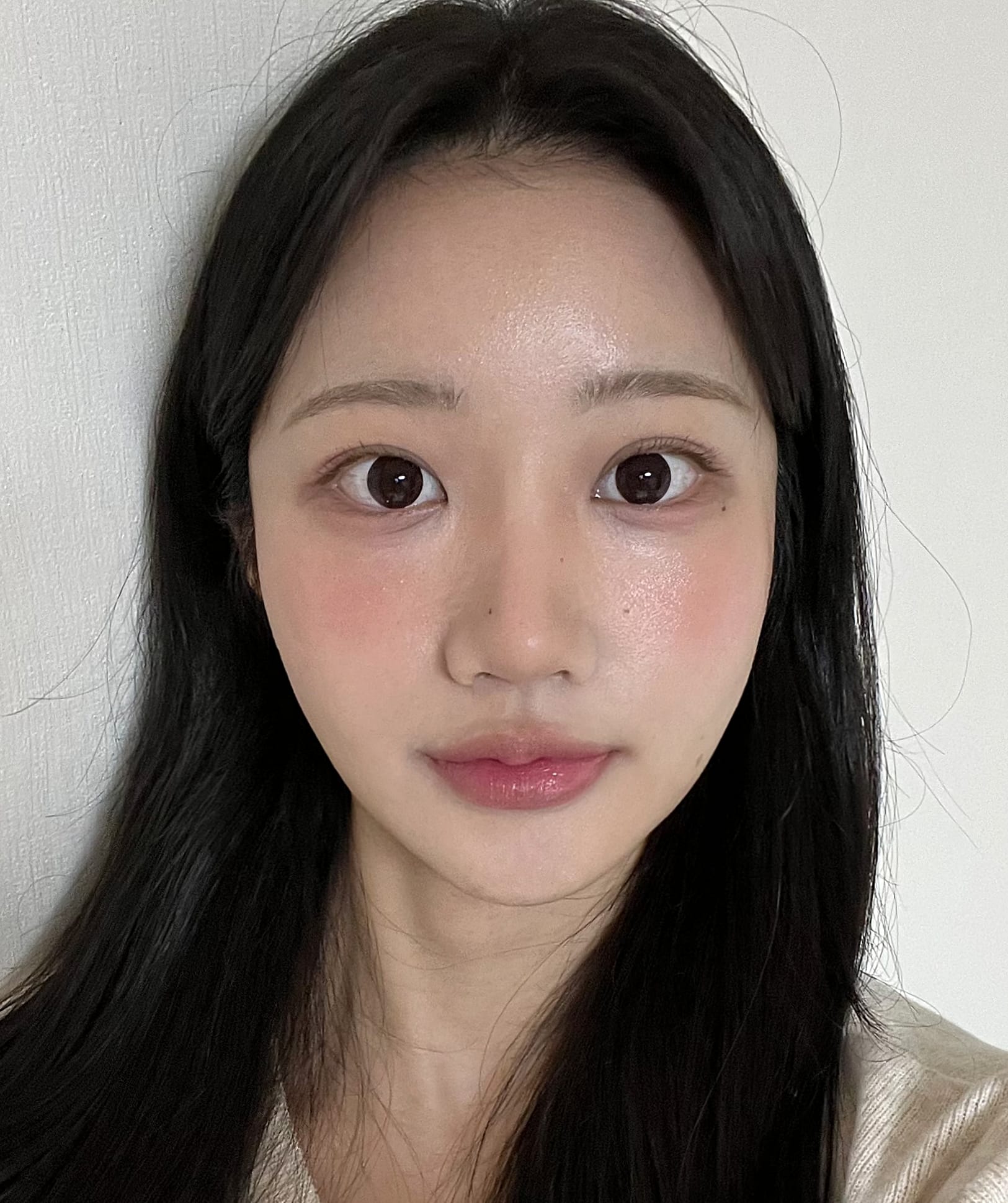 얼굴지방이식 수술 후