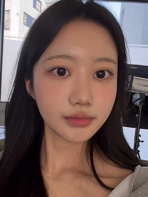 얼굴지방이식 수술 후