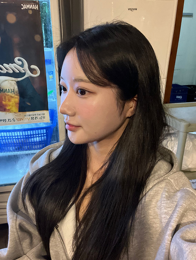 얼굴지방이식 수술 후