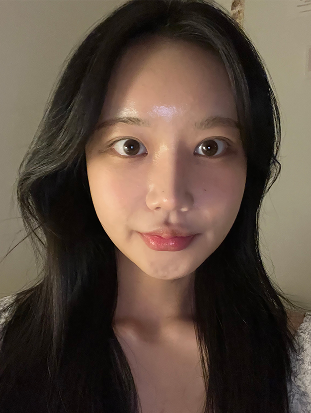 얼굴지방이식 수술 후