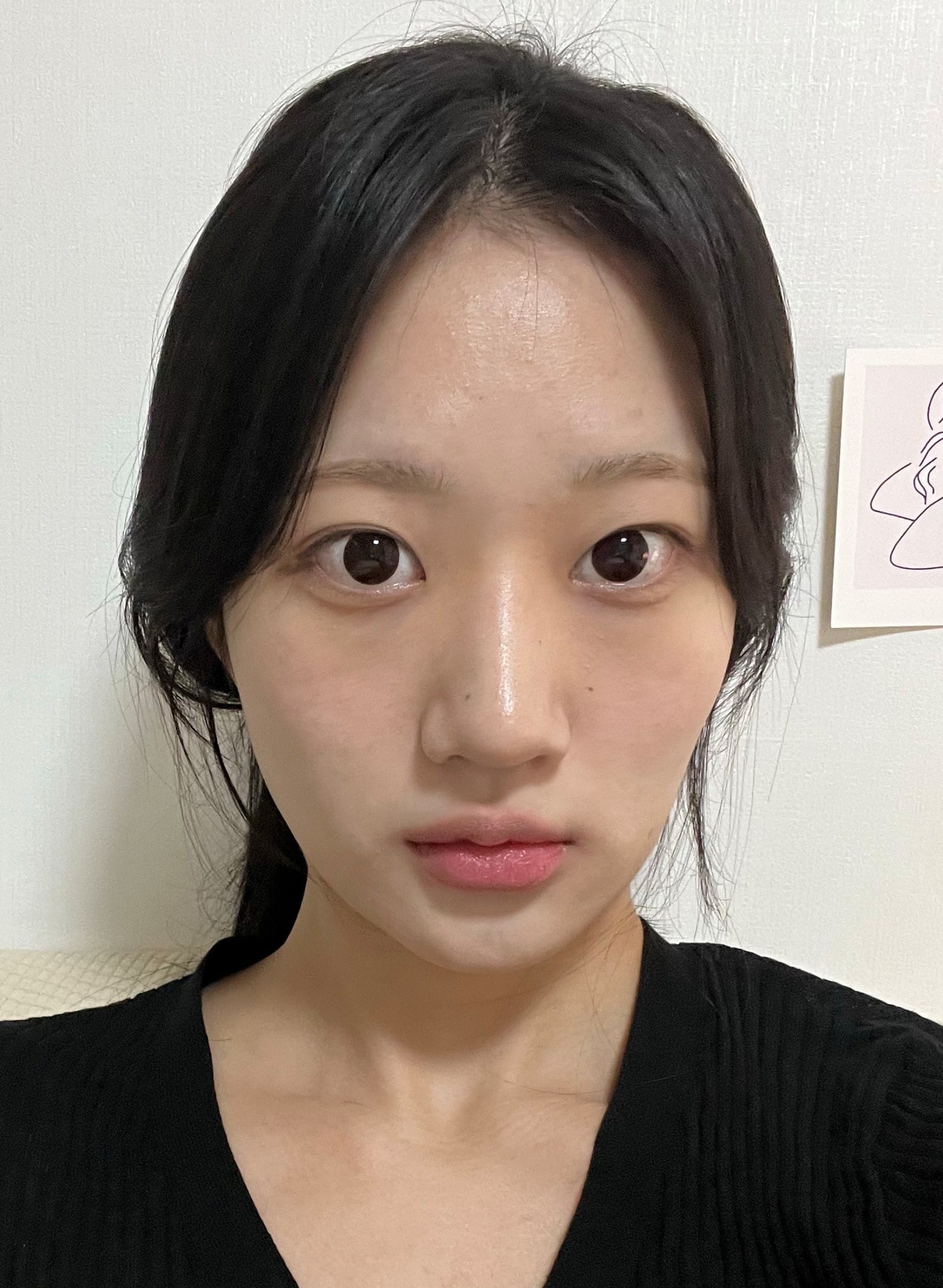얼굴지방이식 수술 전