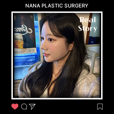 얼굴지방이식 전후 변화 리얼후기 썸네일