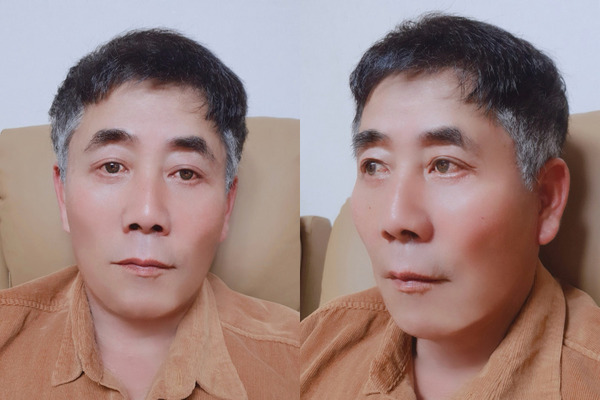 안면거상, 이마거상 수술 후