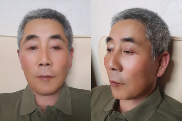 안면거상, 이마거상 수술 후