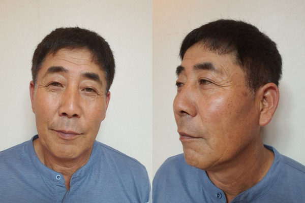 안면거상, 이마거상 수술 전